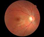 Photo of retina