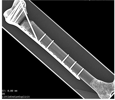 X-ray showing a long bone with internal metal fixation hardware and a clamp-like tool.