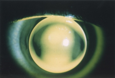keratoconus.jpg (23259 bytes)